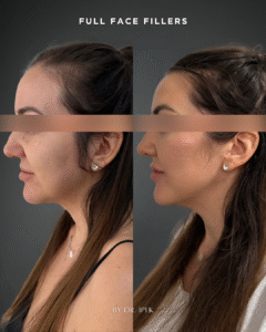 skinboosters хидратация кожа Пловдив млада кожа