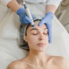 Fotona Acne & Acne Scar Revision - Лечение на активно акне